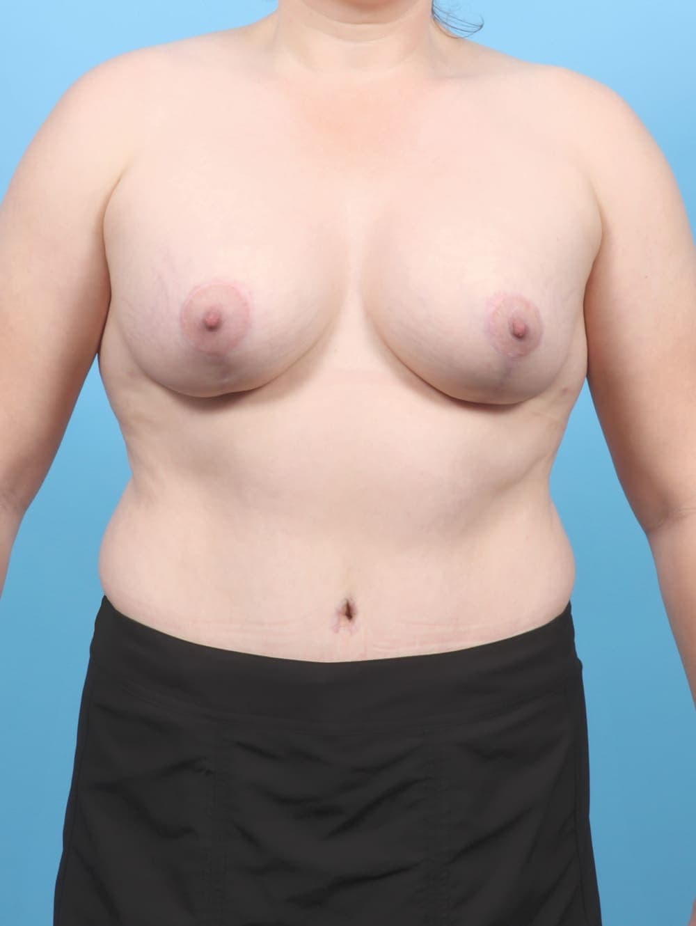 Breast Lift/Reduction case #6547 after