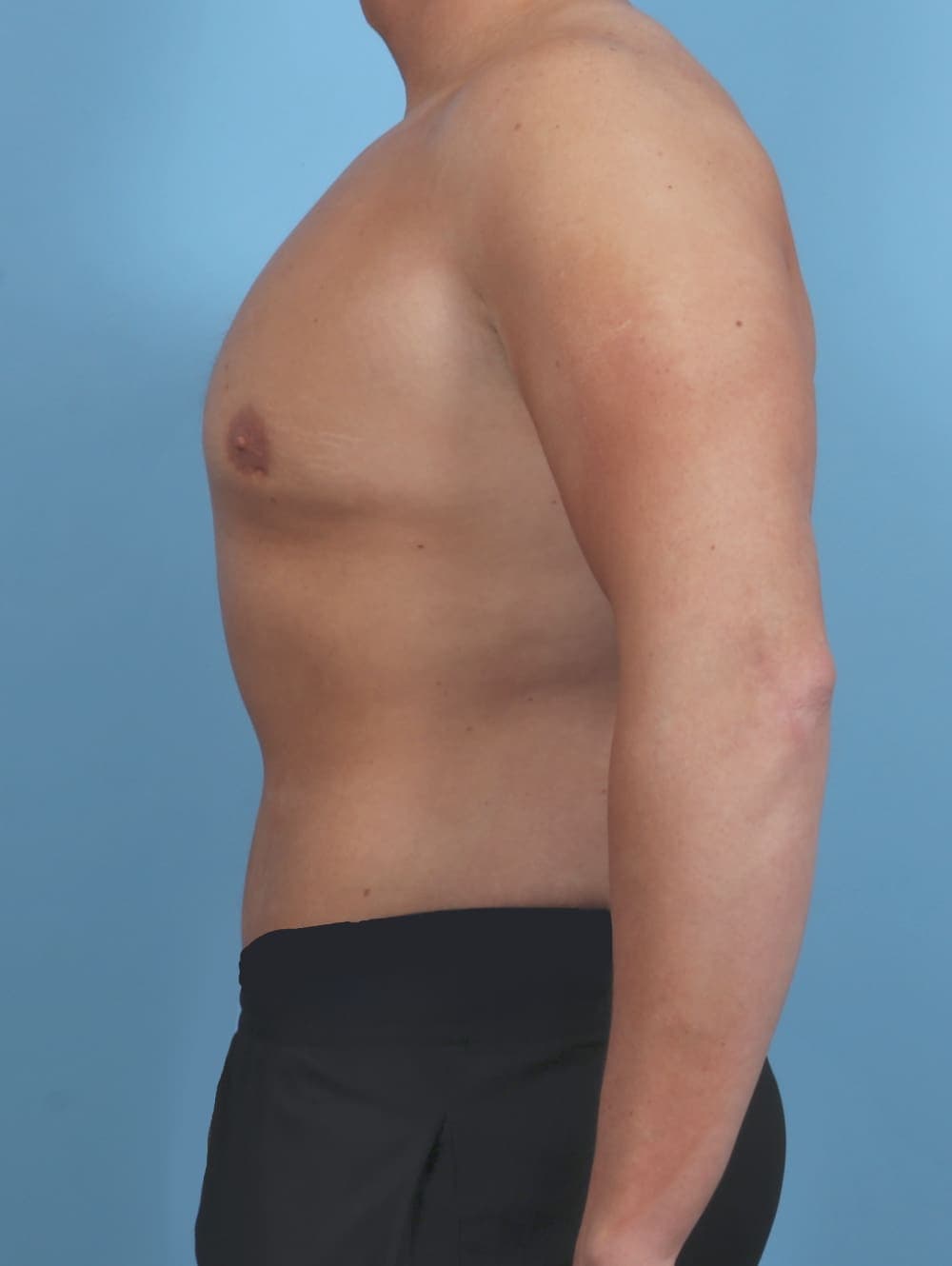 Body Lift case #4892 after, image 3