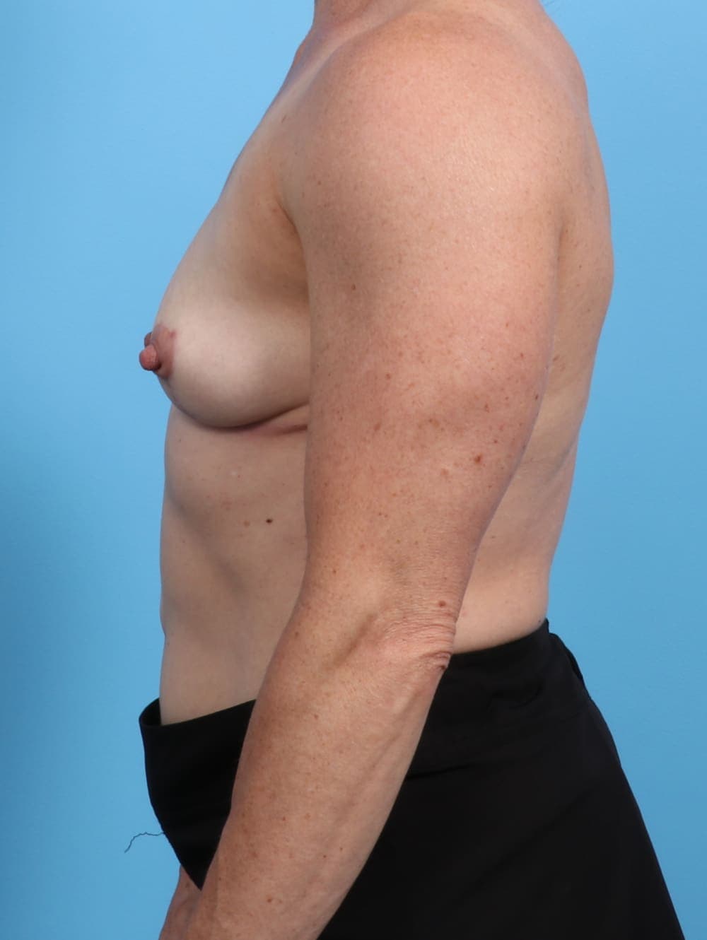 Breast Implant Removal with Lift case #2763 after, image 3