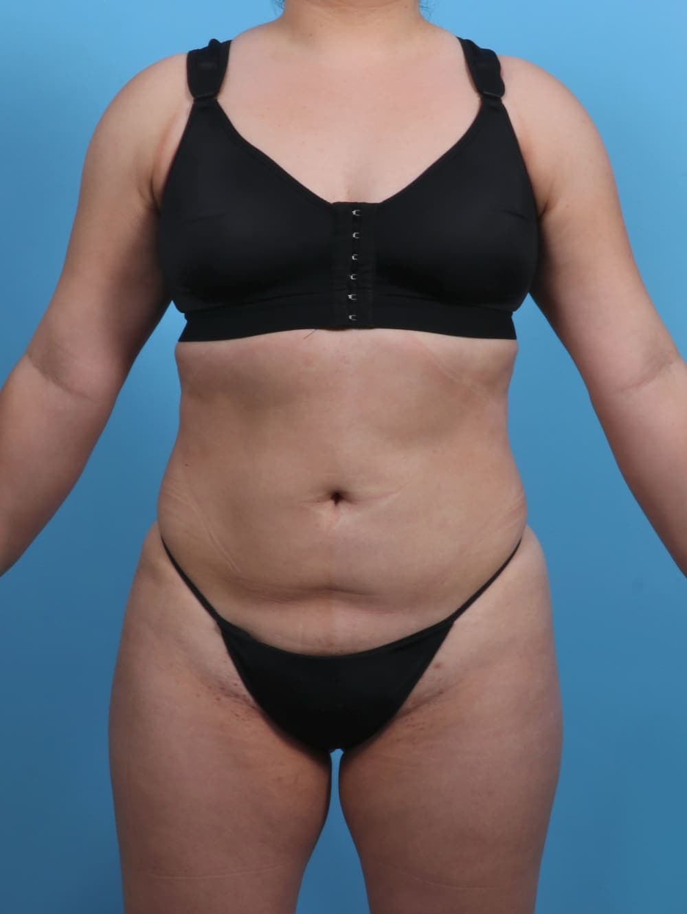 Liposuction case #3683 after