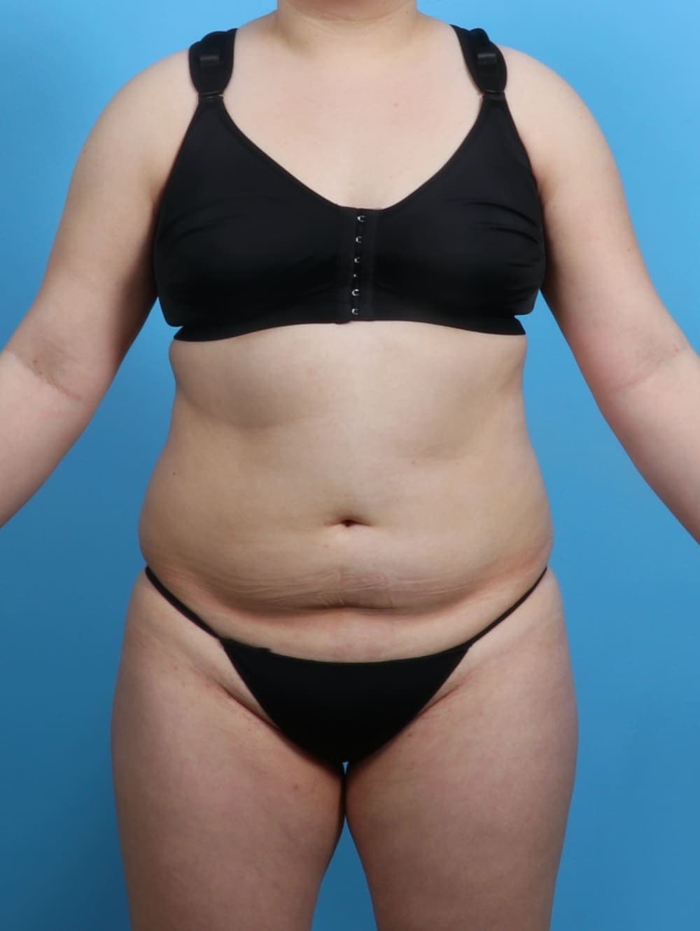 Liposuction case #3683 before