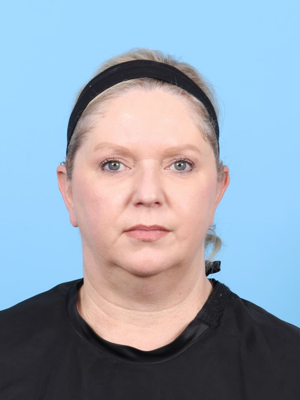 Eyelid Surgery case #6523 after