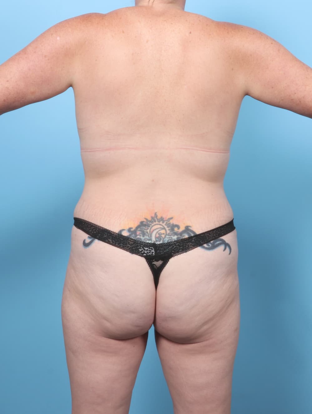 Breast Augmentation case #8360 after, image 4