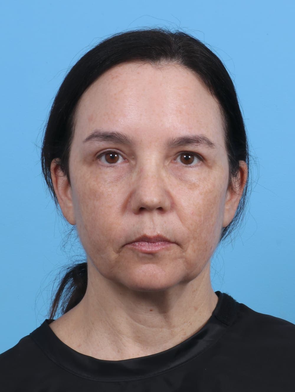 Eyelid Surgery case #4179 after