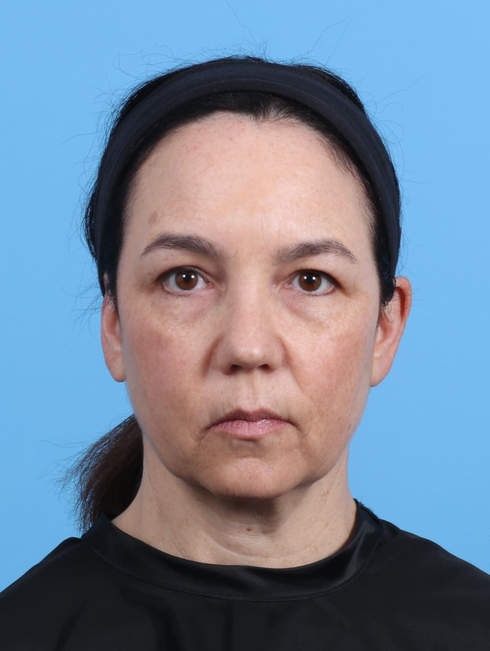 Eyelid Surgery case #4179 before