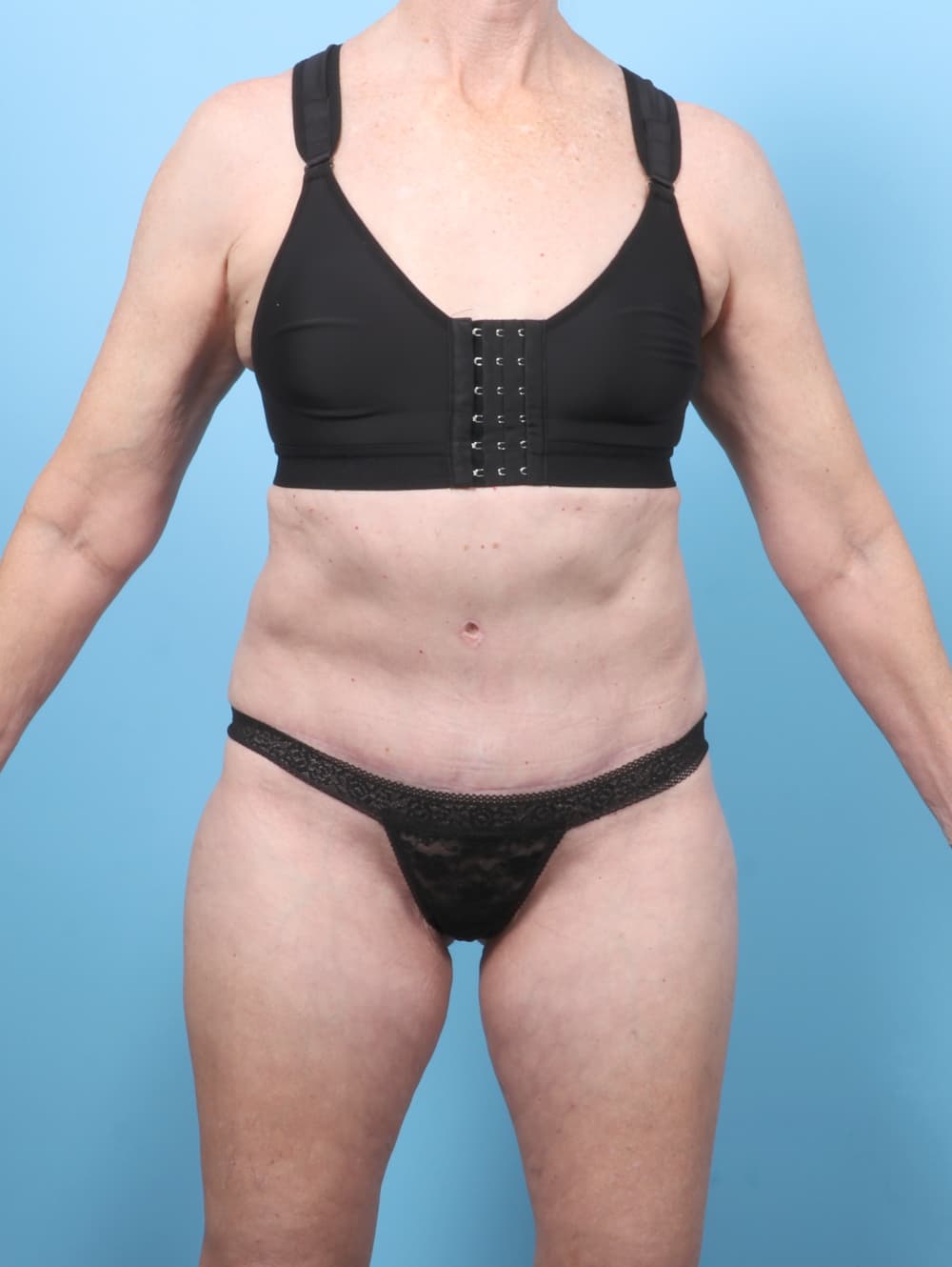 Body Contouring case #8046 after