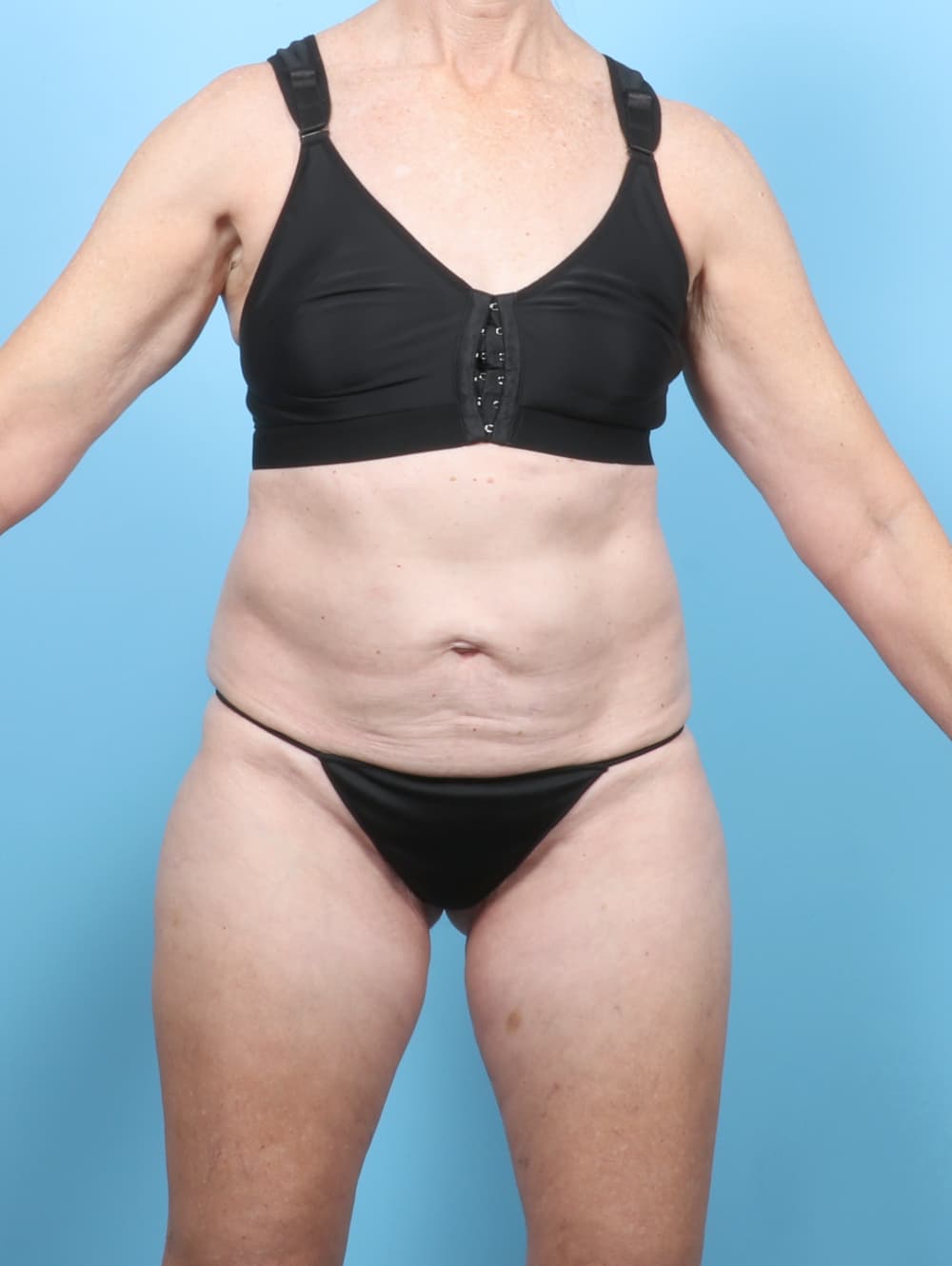 Body Contouring case #8046 before