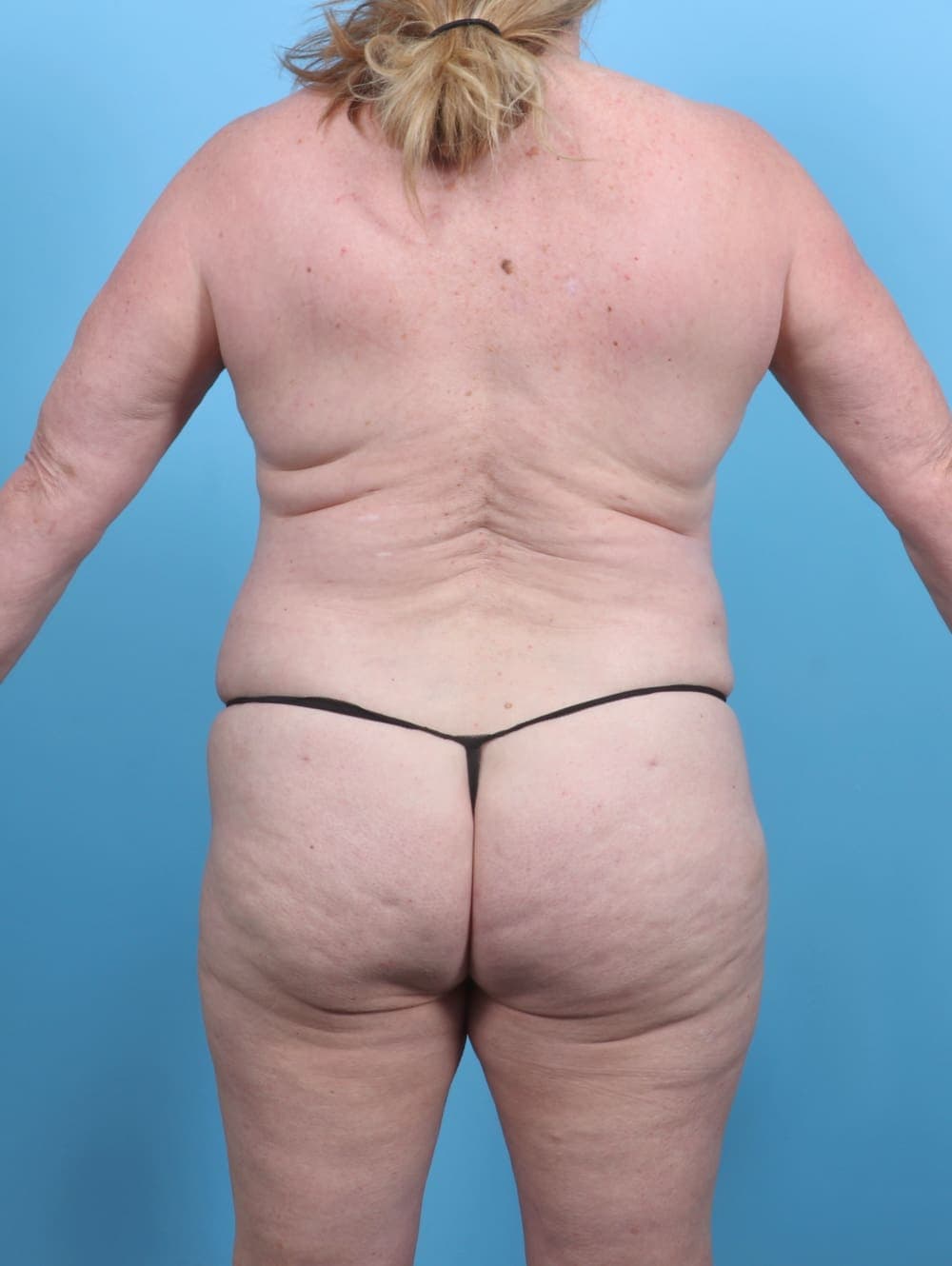 Tummy Tuck case #5592 after, image 2