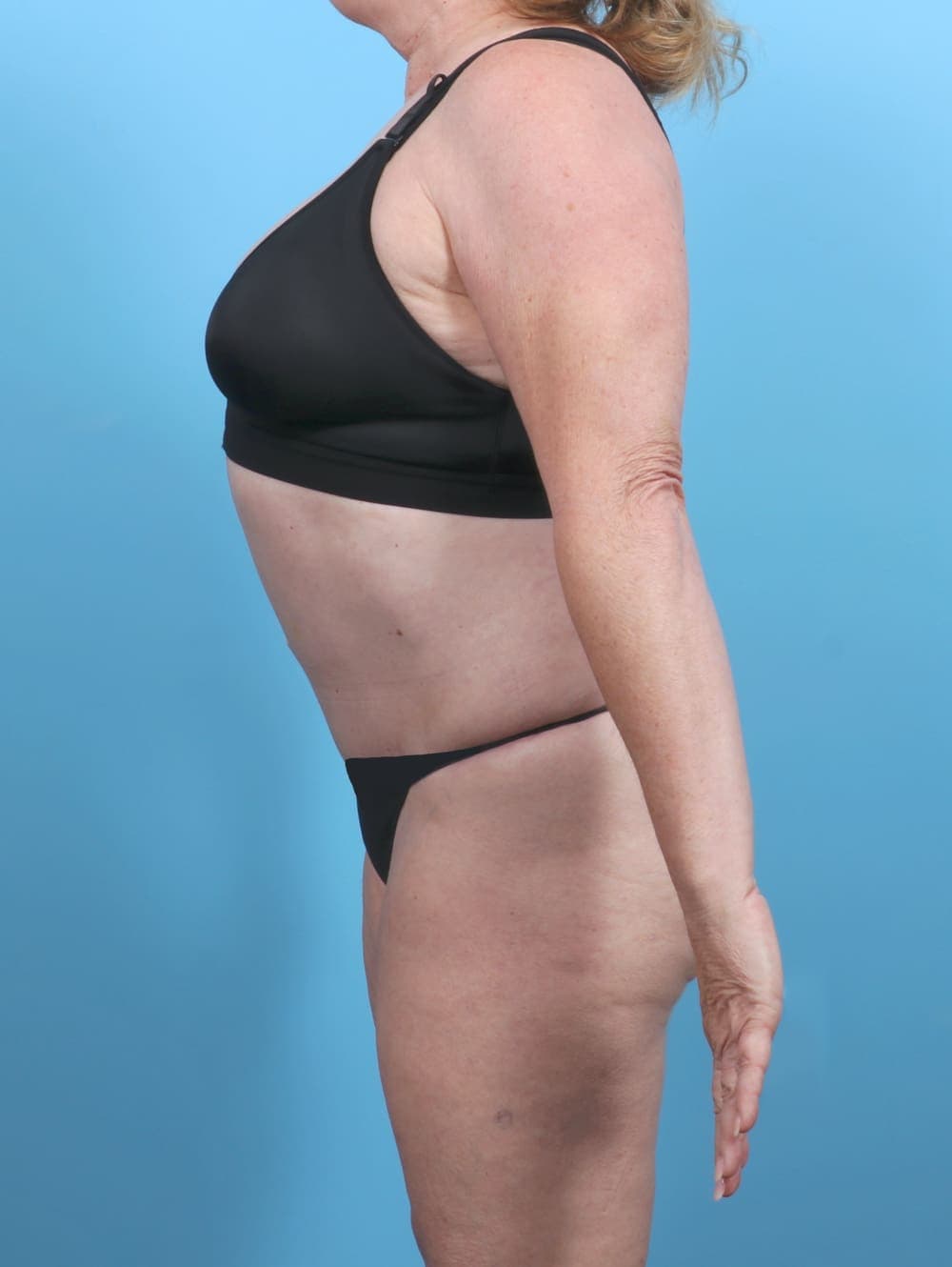 Tummy Tuck case #5592 after, image 4