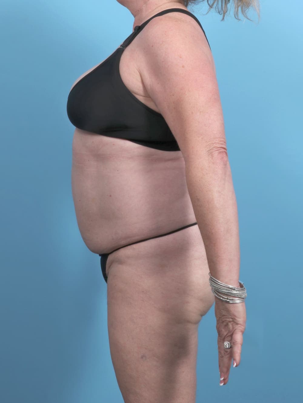 Tummy Tuck case #5592 before, image 4