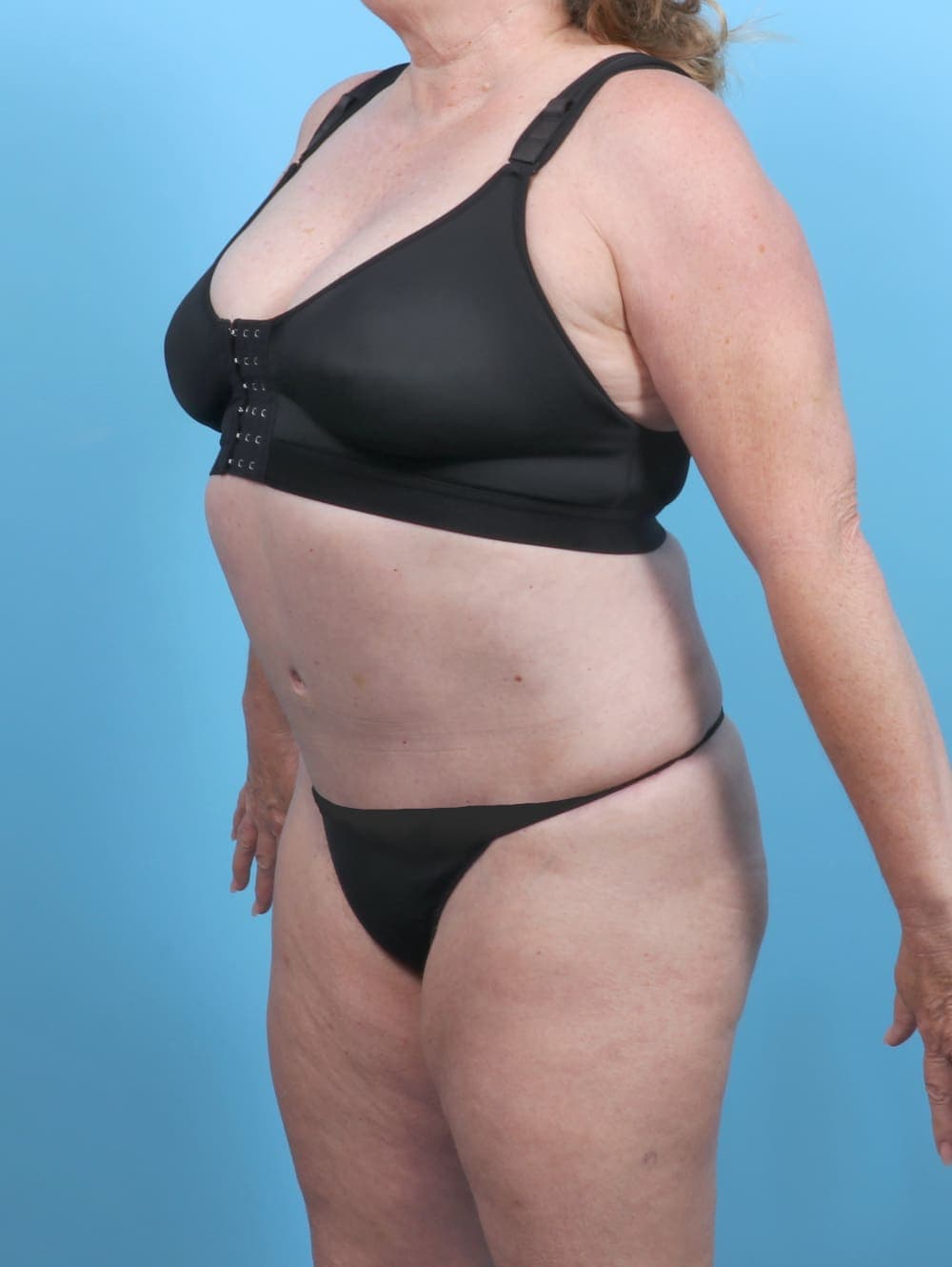 Tummy Tuck case #5592 after, image 3