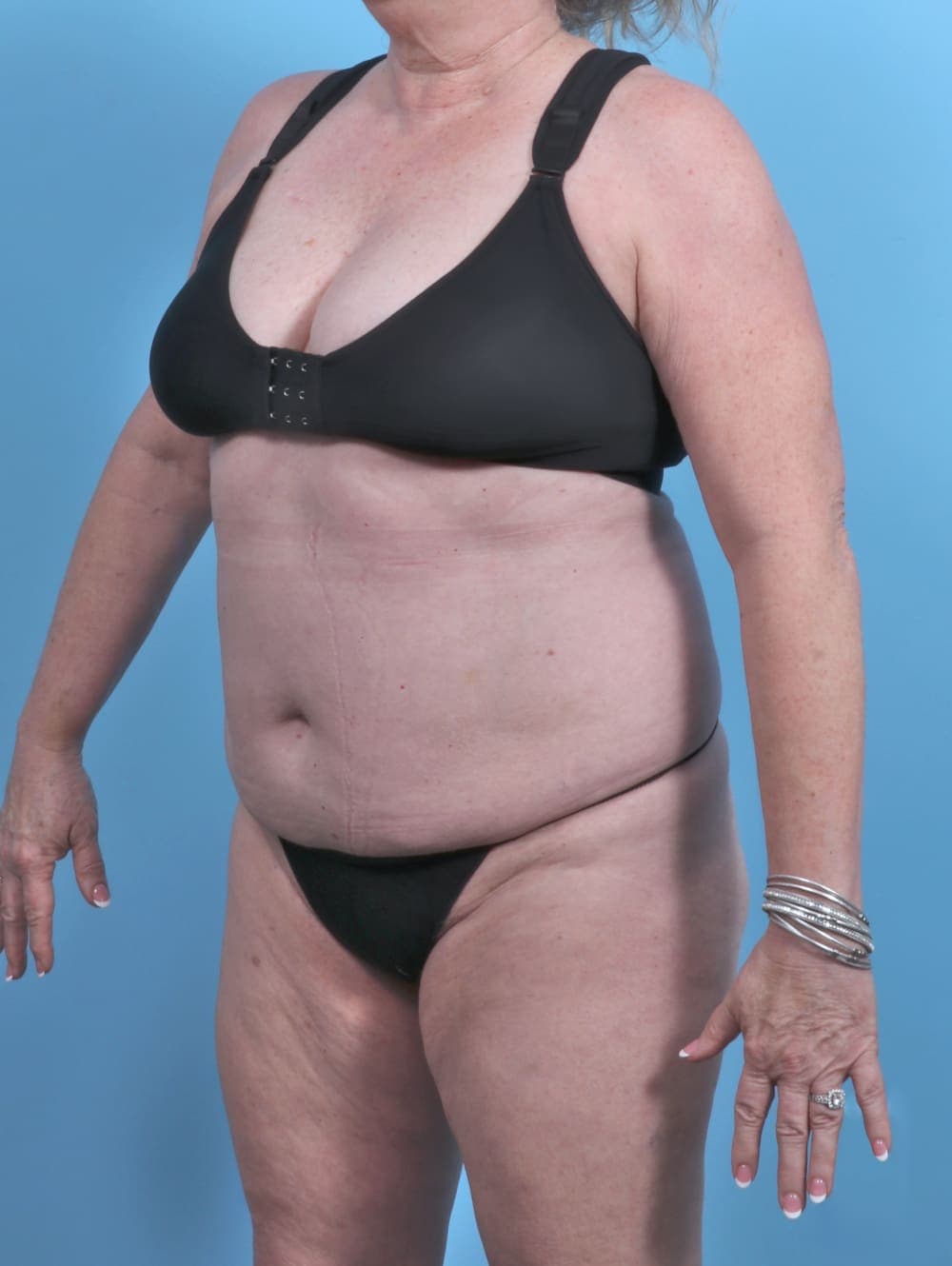 Tummy Tuck case #5592 before, image 3