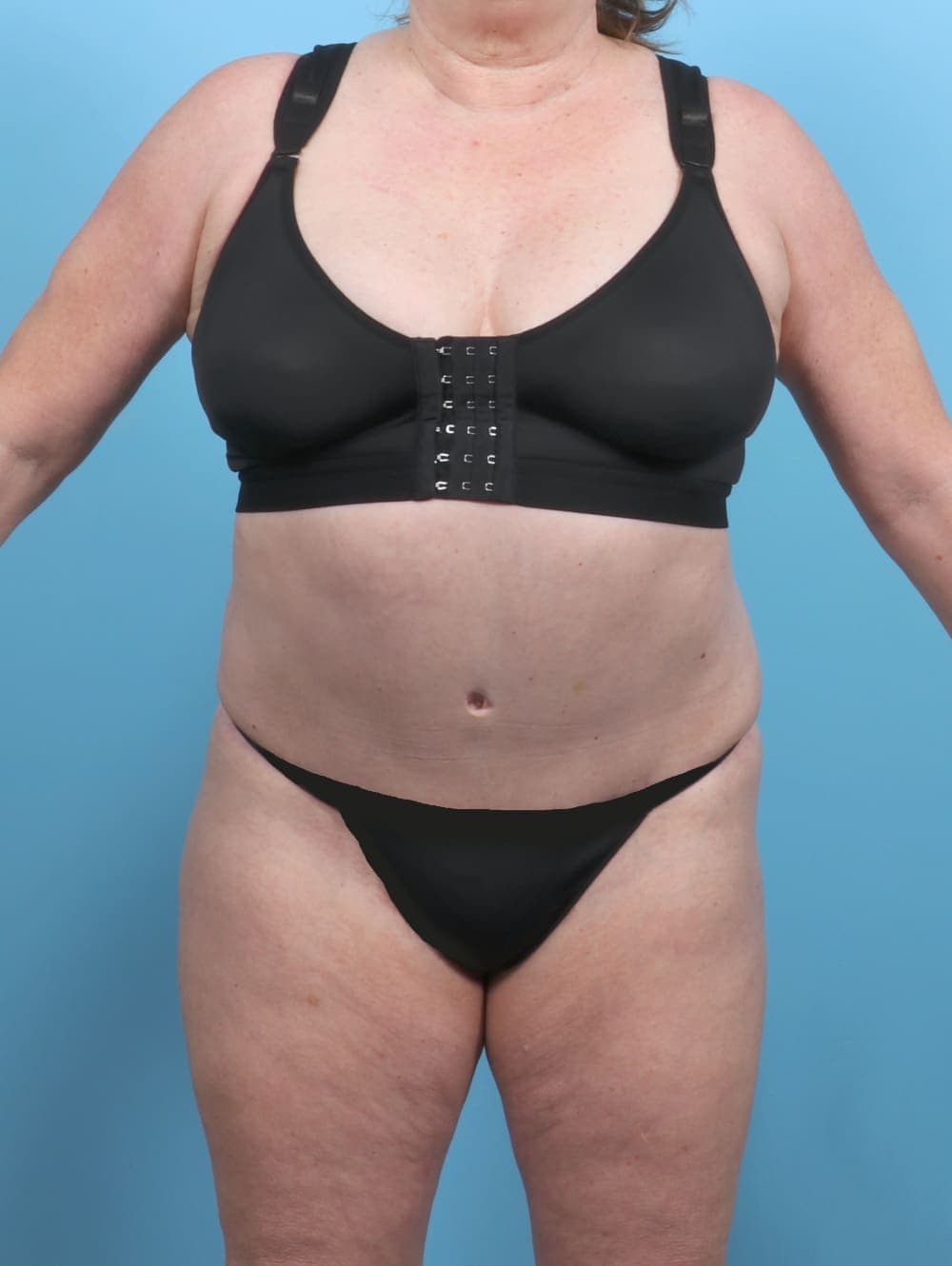 Liposuction case #5592 after