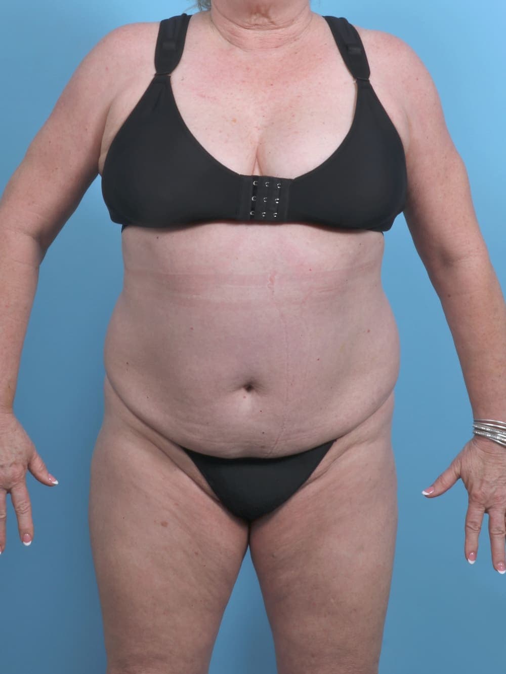 Liposuction case #5592 before