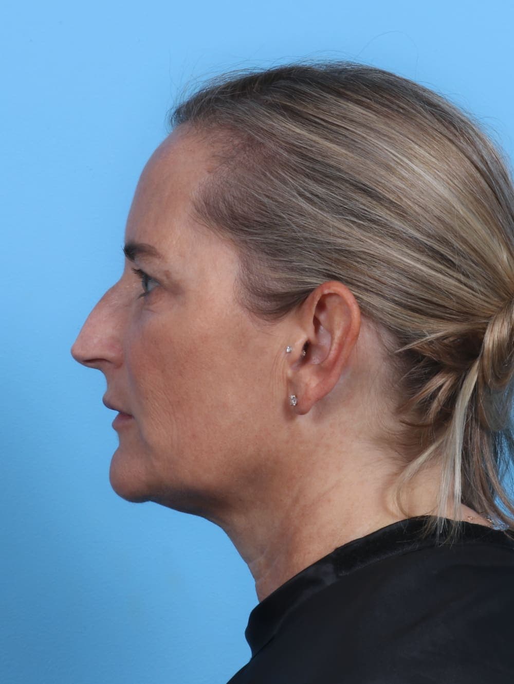 Eyelid Surgery case #3675 after, image 3