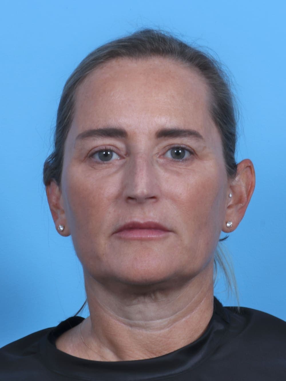 Eyelid Surgery case #3675 after