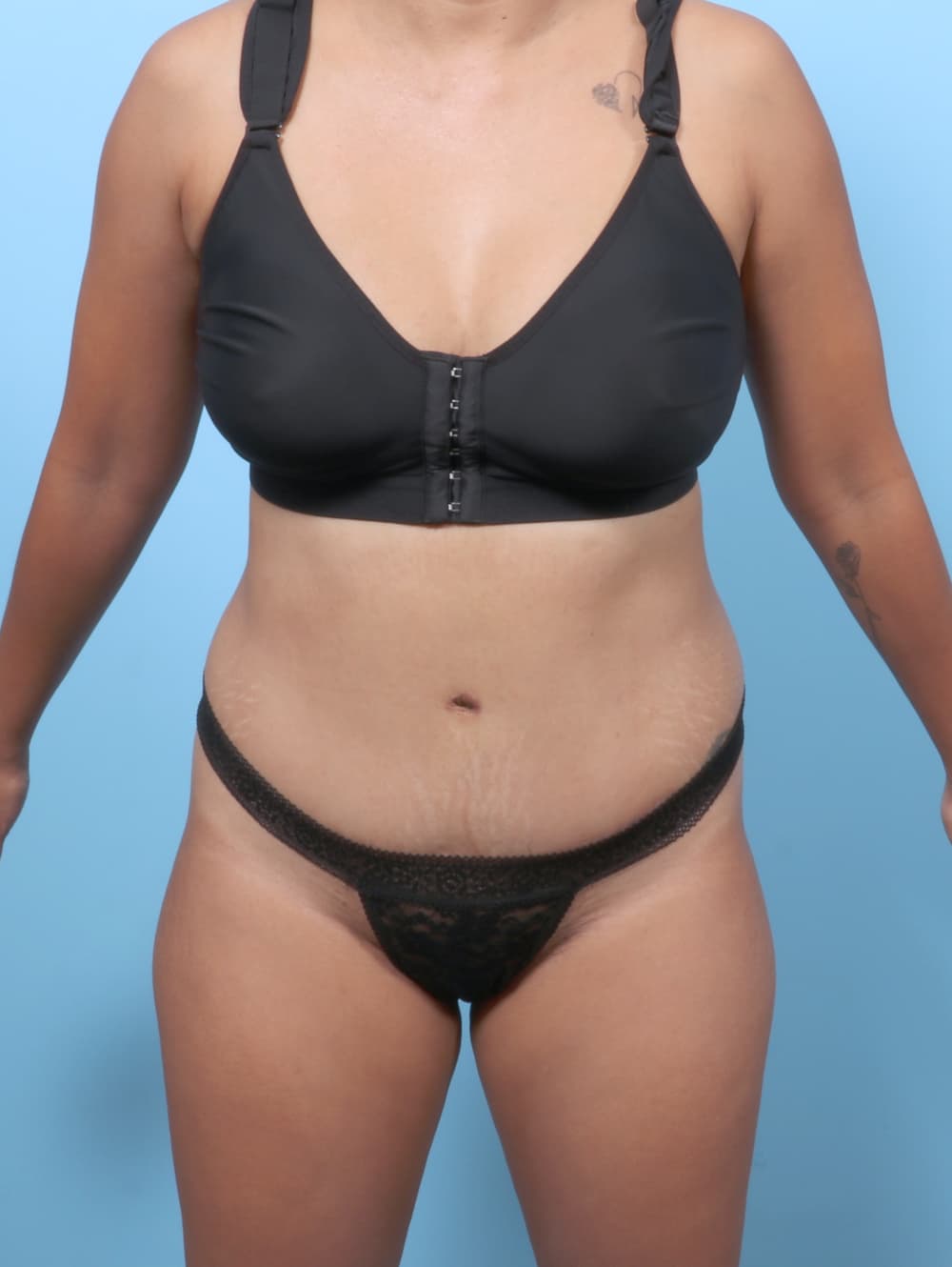 Body Contouring case #8338 after