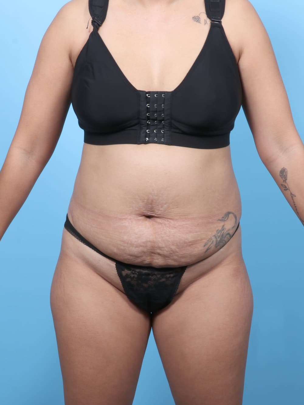 Body Contouring case #8338 before