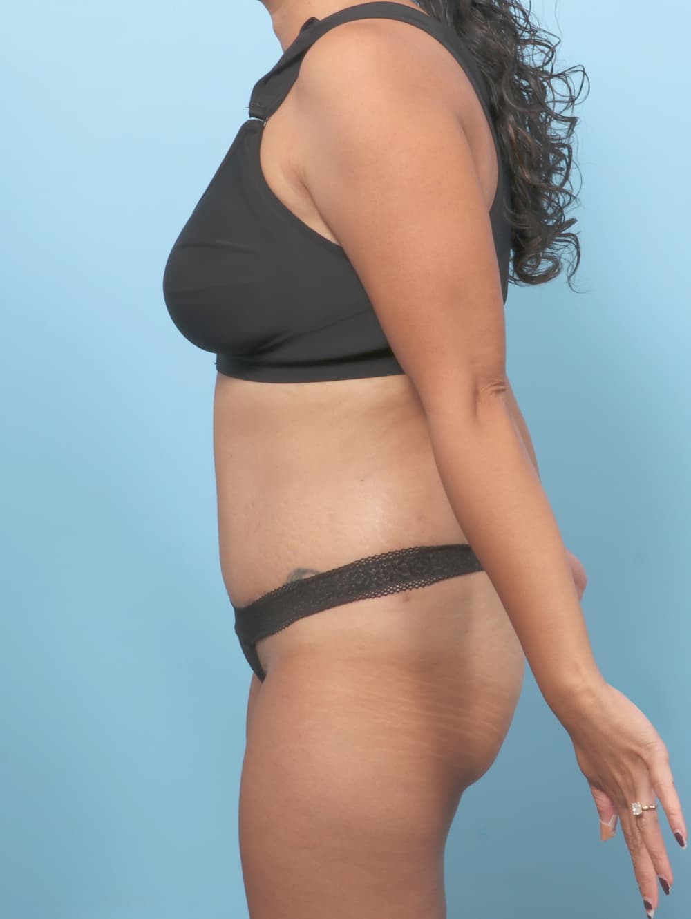 Tummy Tuck case #8338 after, image 3