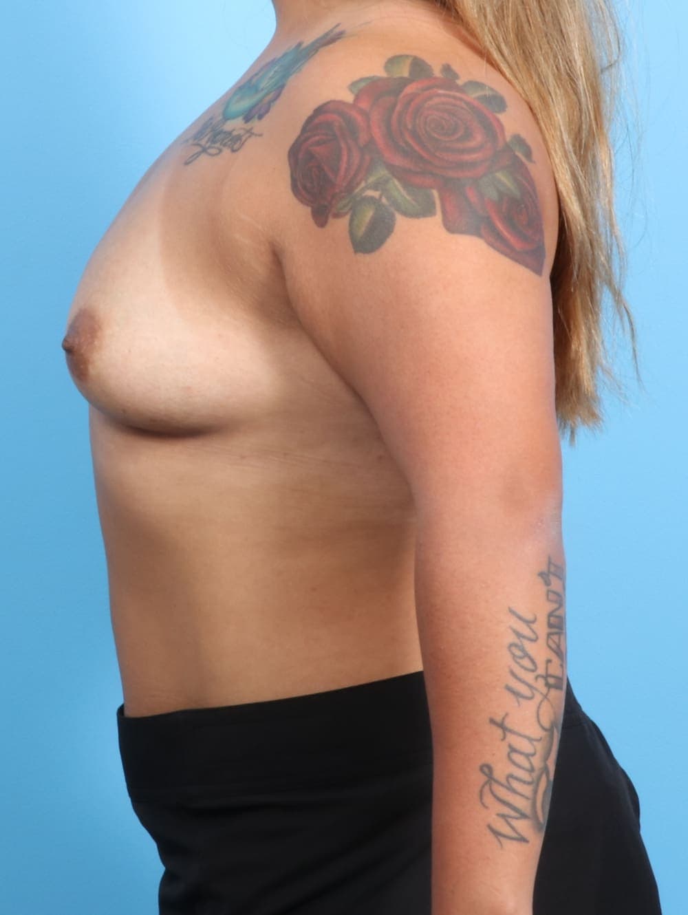 Breast Augmentation case #2290 before, image 3