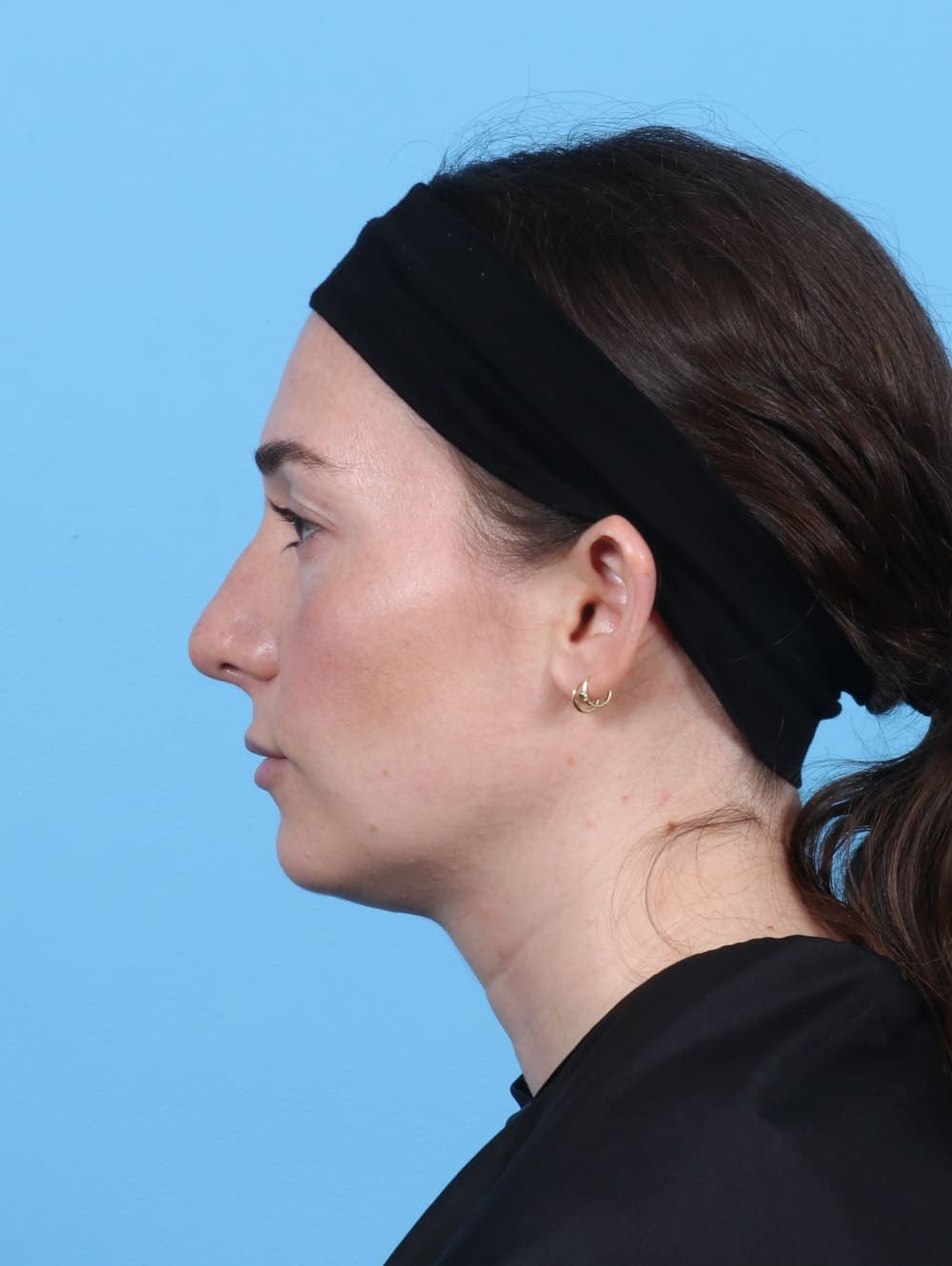 Facial Surgery case #5325 after