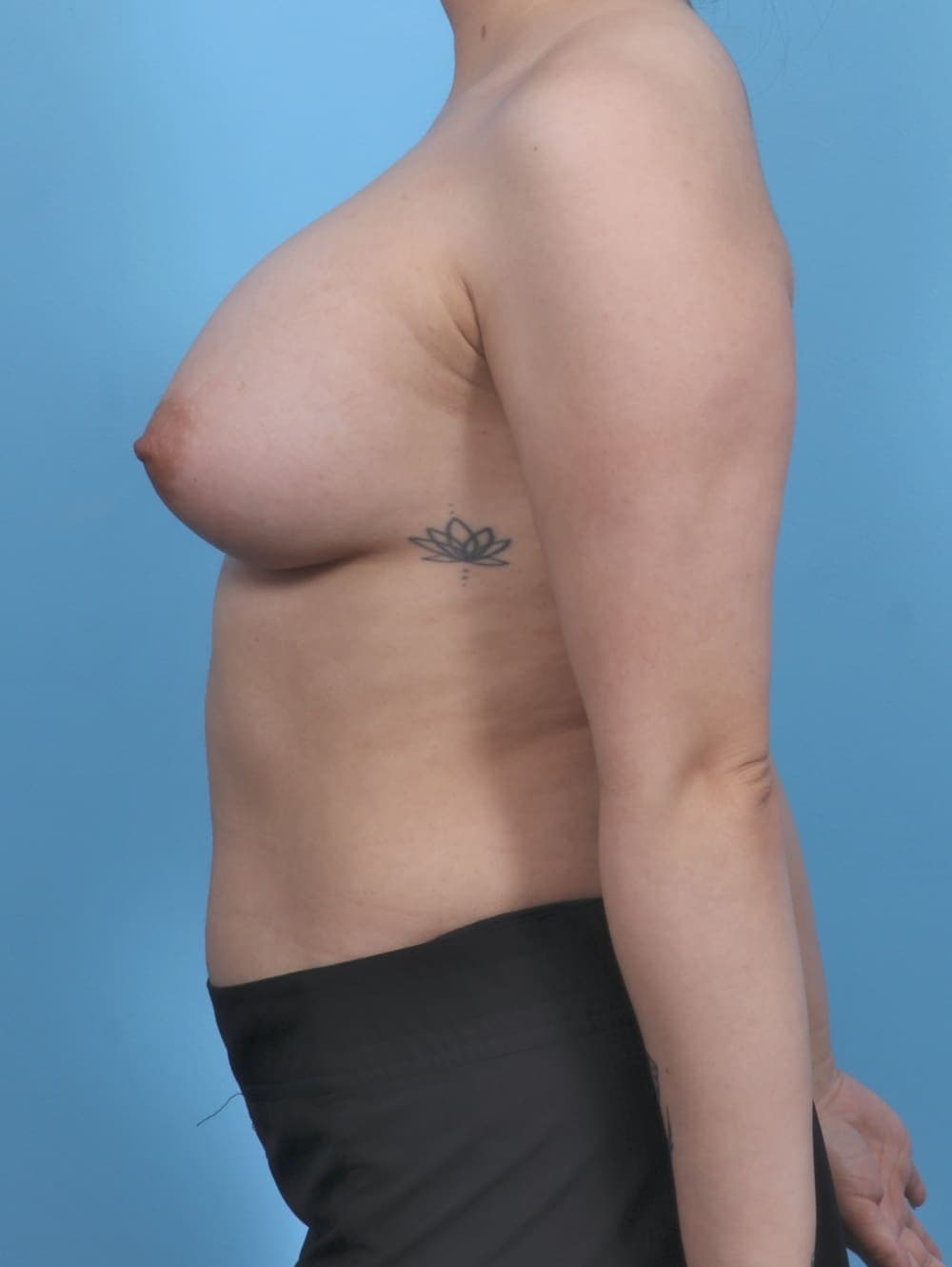 Breast Augmentation case #5257 after, image 3