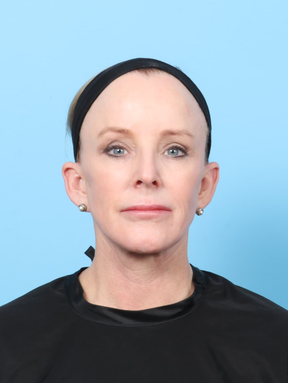 Facial Surgery case #7429 after