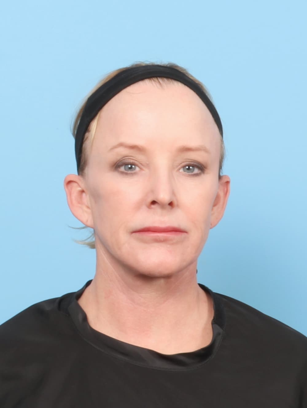 Facial Surgery case #7429 before