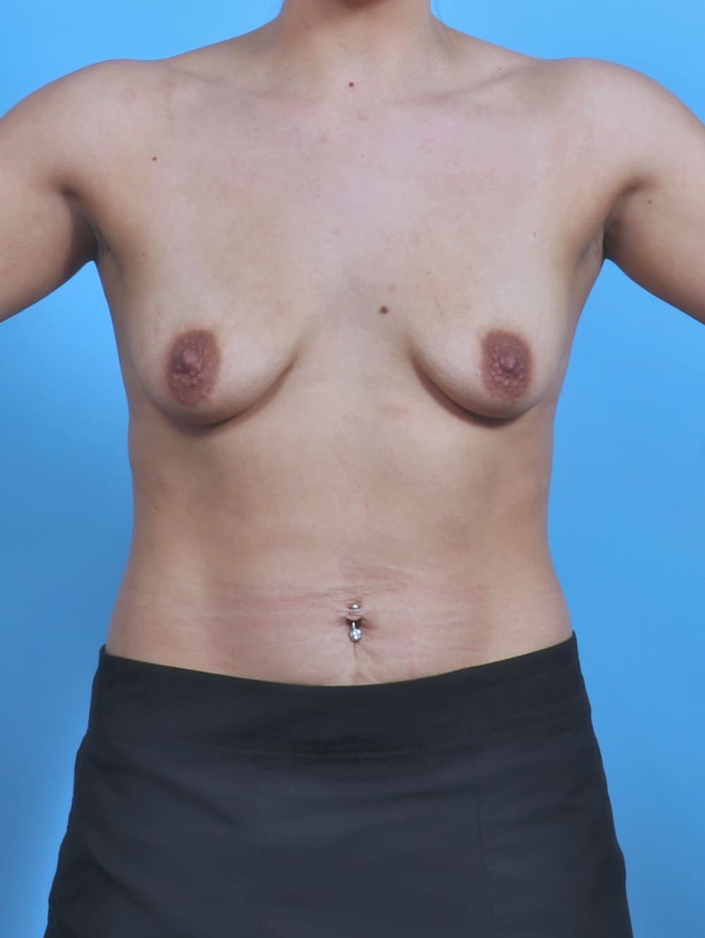 Breast Lift with Implants case #5560 before