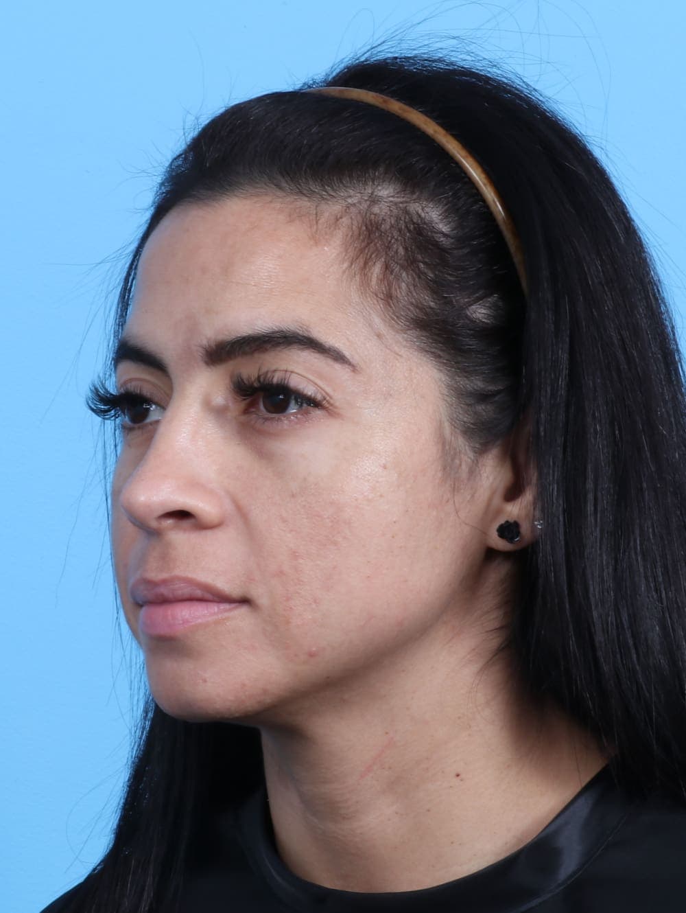 Rhinoplasty case #2771 after, image 3