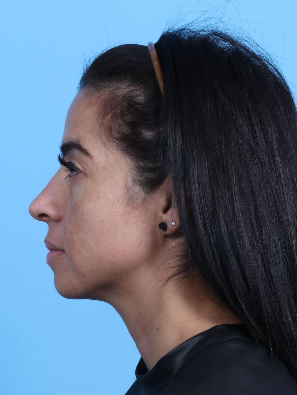 Rhinoplasty case #2771 after