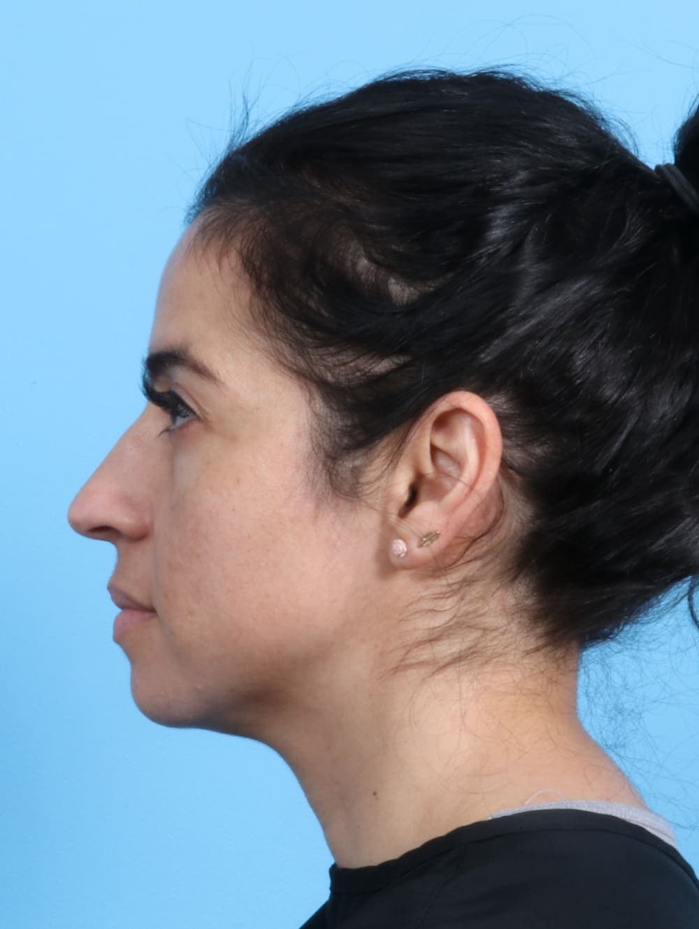 Rhinoplasty case #2771 before