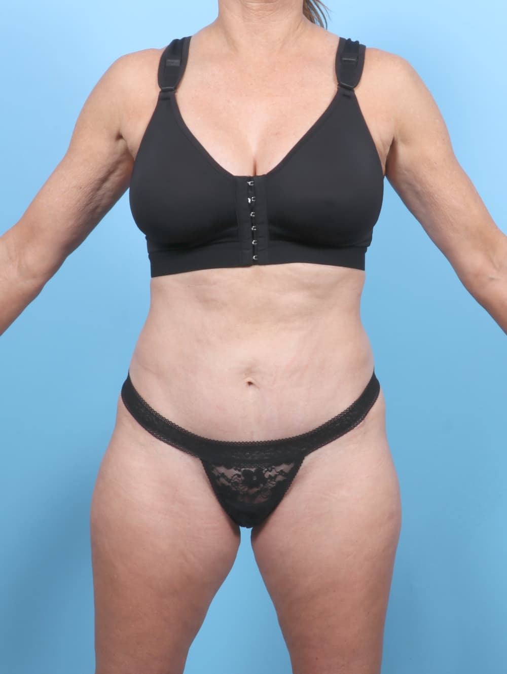 Tummy Tuck case #7323 after