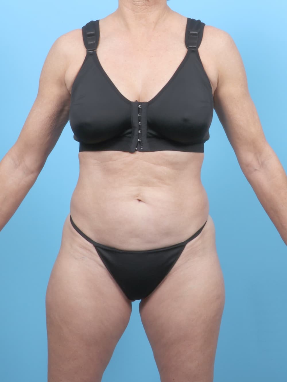 Tummy Tuck case #7323 before