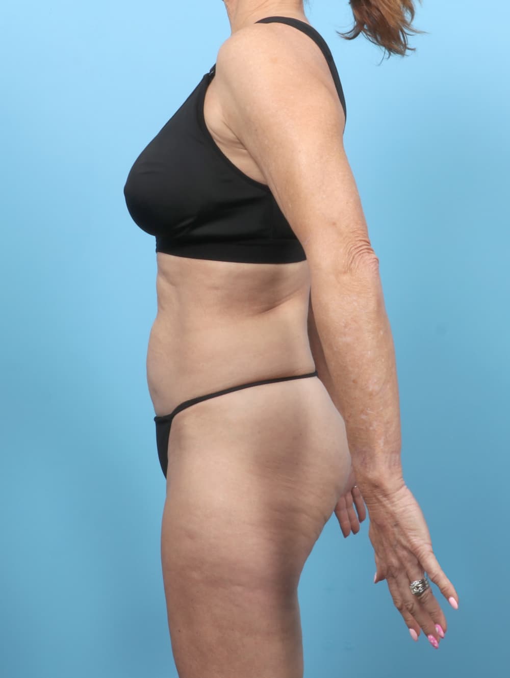 Tummy Tuck case #7323 before, image 3