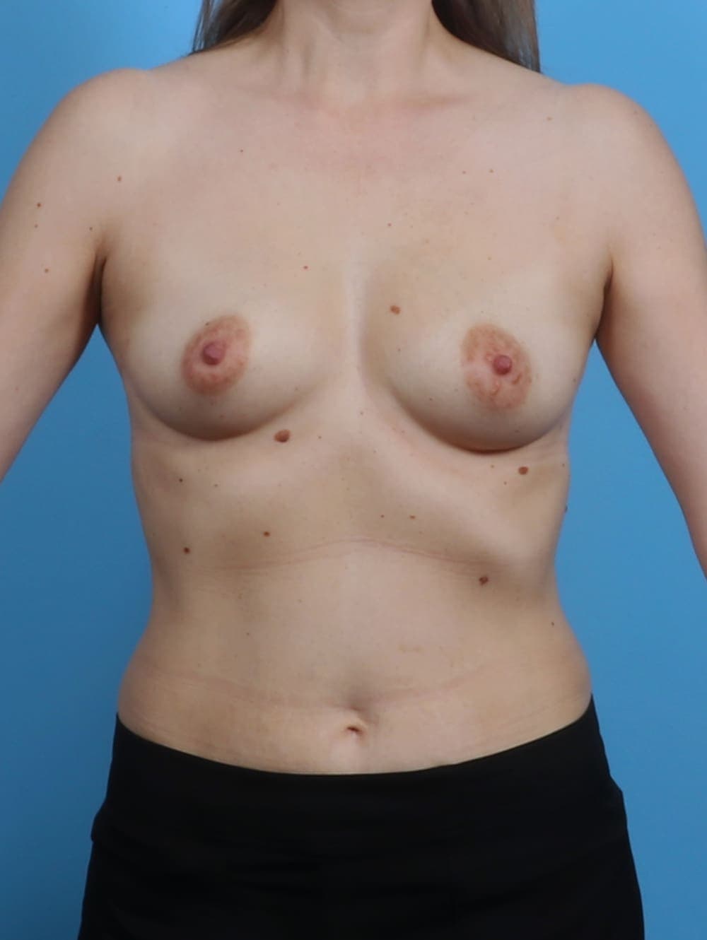 Breast Augmentation case #4203 before