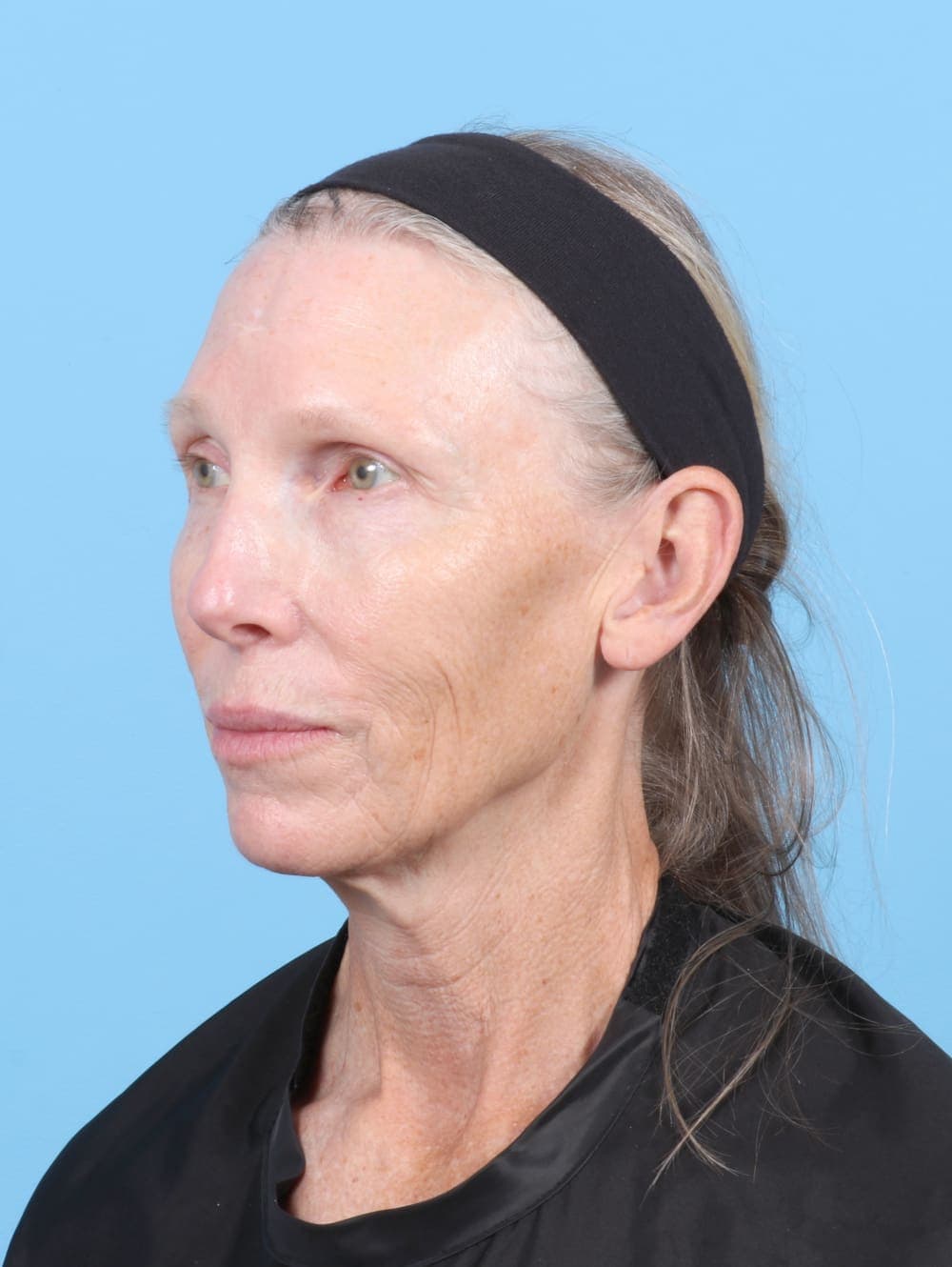 Eyelid Surgery case #6725 before, image 2