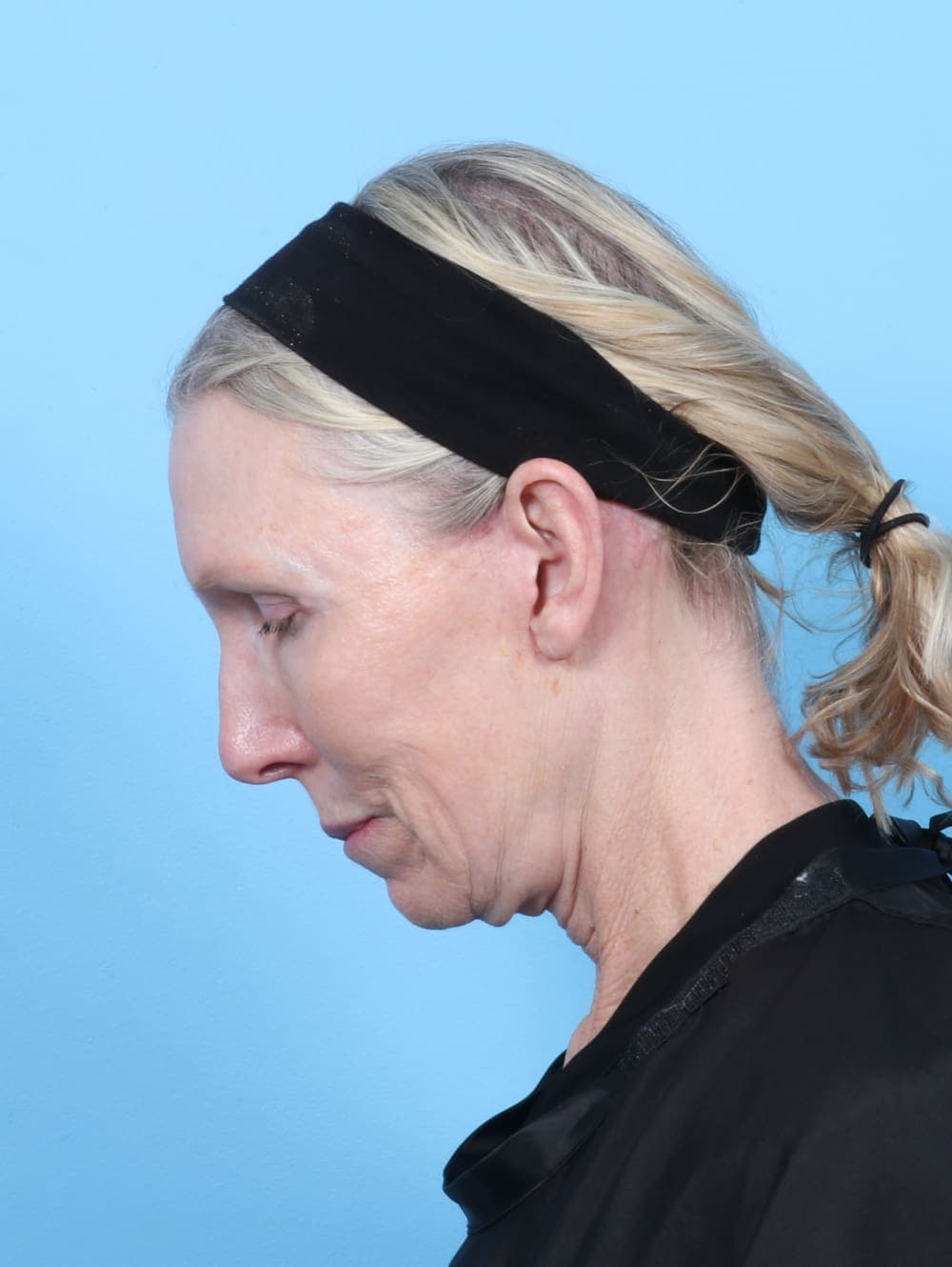 Eyelid Surgery case #6725 after, image 4