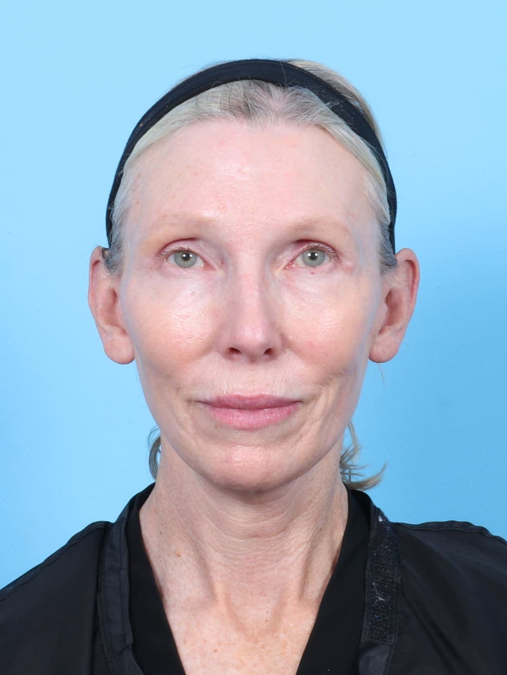 Facial Surgery case #6725 after