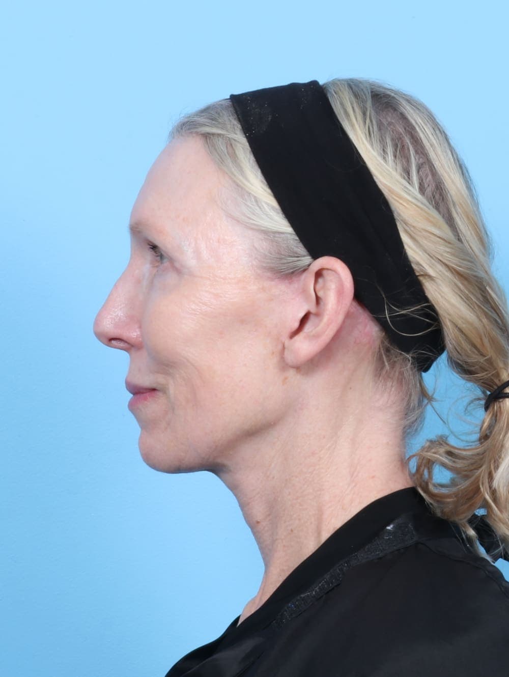 Eyelid Surgery case #6725 after, image 3
