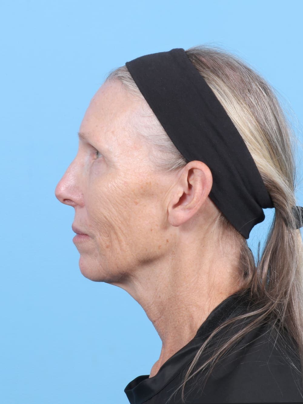 Eyelid Surgery case #6725 before, image 3