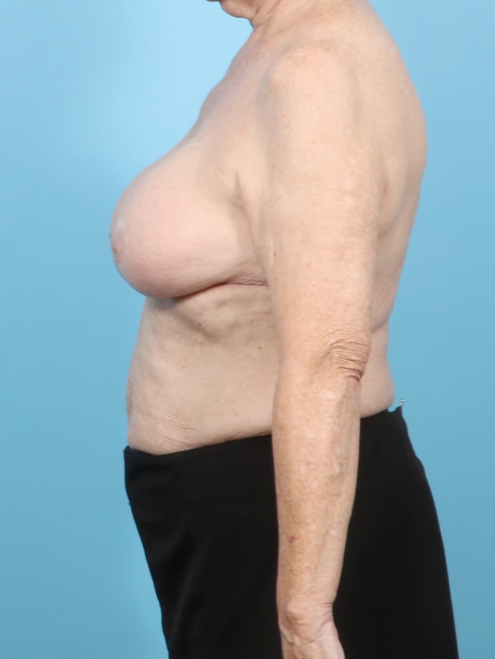 Breast Implant Removal with Lift case #7437 before, image 3