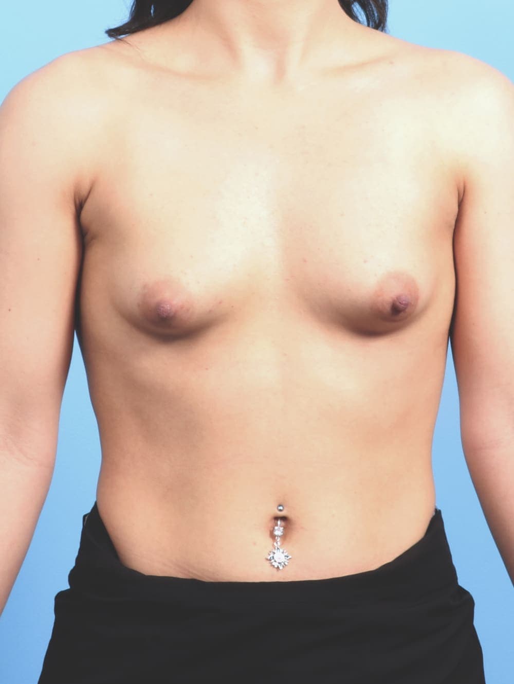 Breast Augmentation case #2601 before
