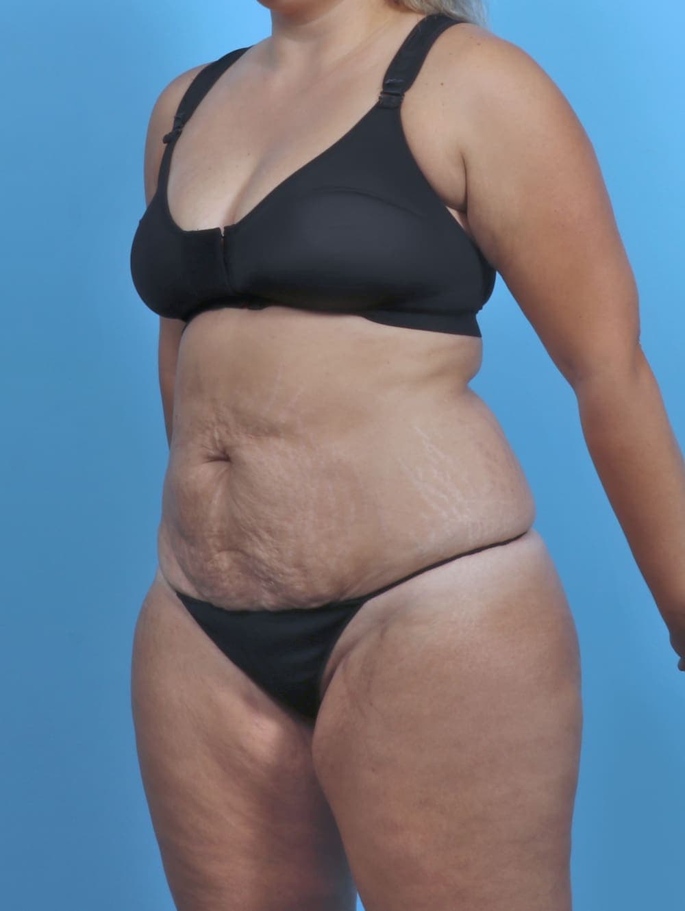 Tummy Tuck case #4954 before, image 2