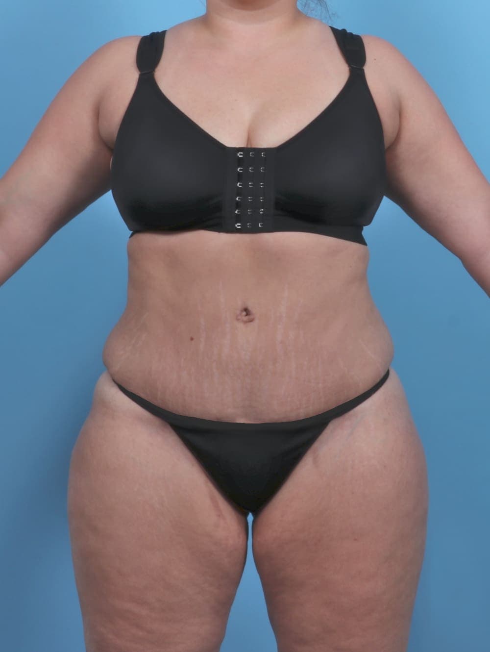 Tummy Tuck case #4954 after, image 1
