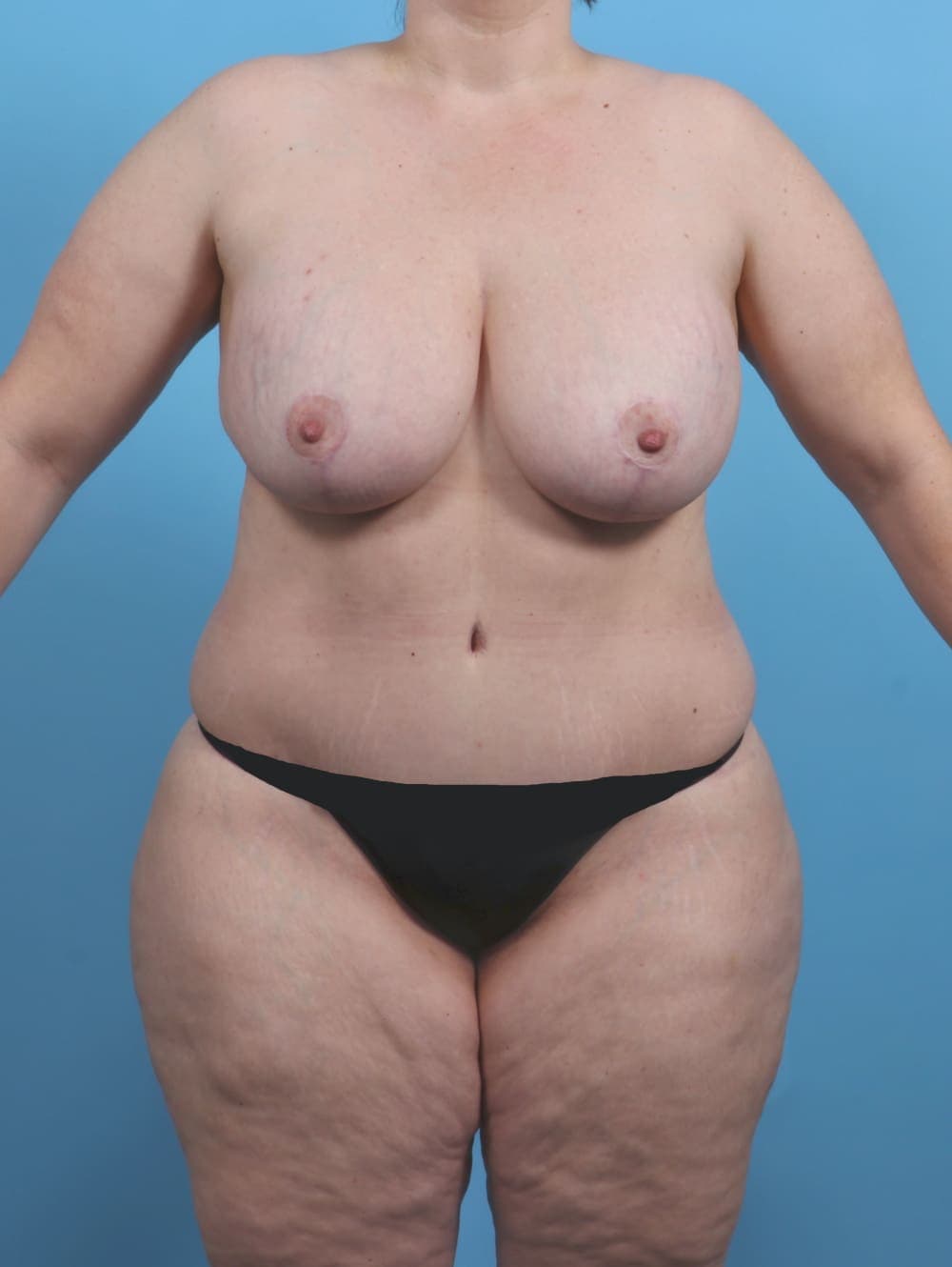 Breast Lift with Implants case #4533 after