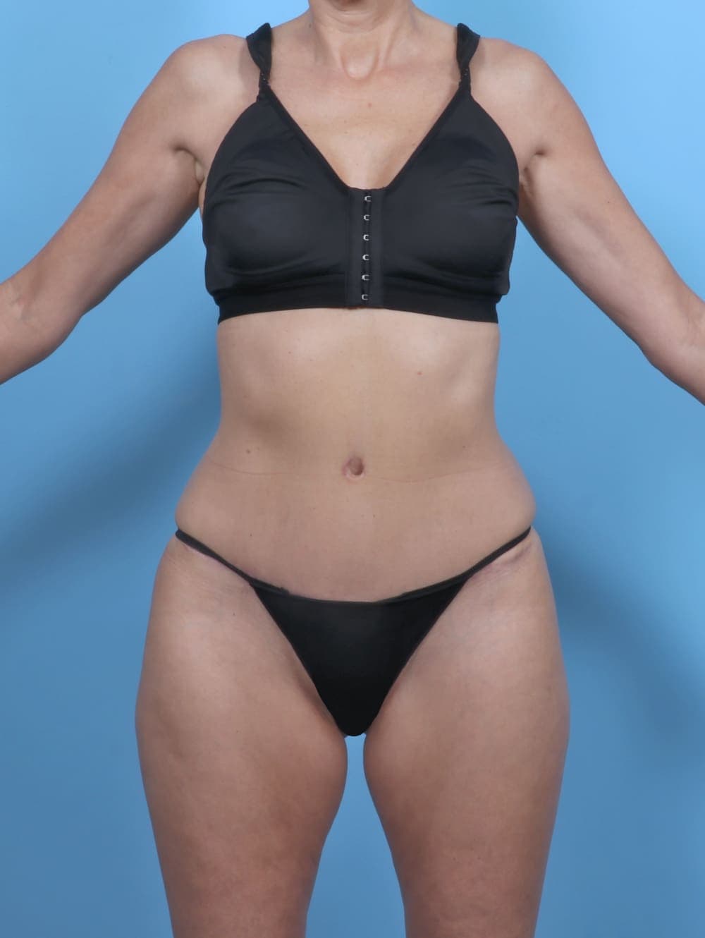 Tummy Tuck case #5333 after