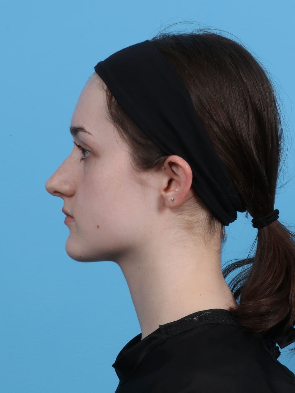Facial Surgery case #4481 before
