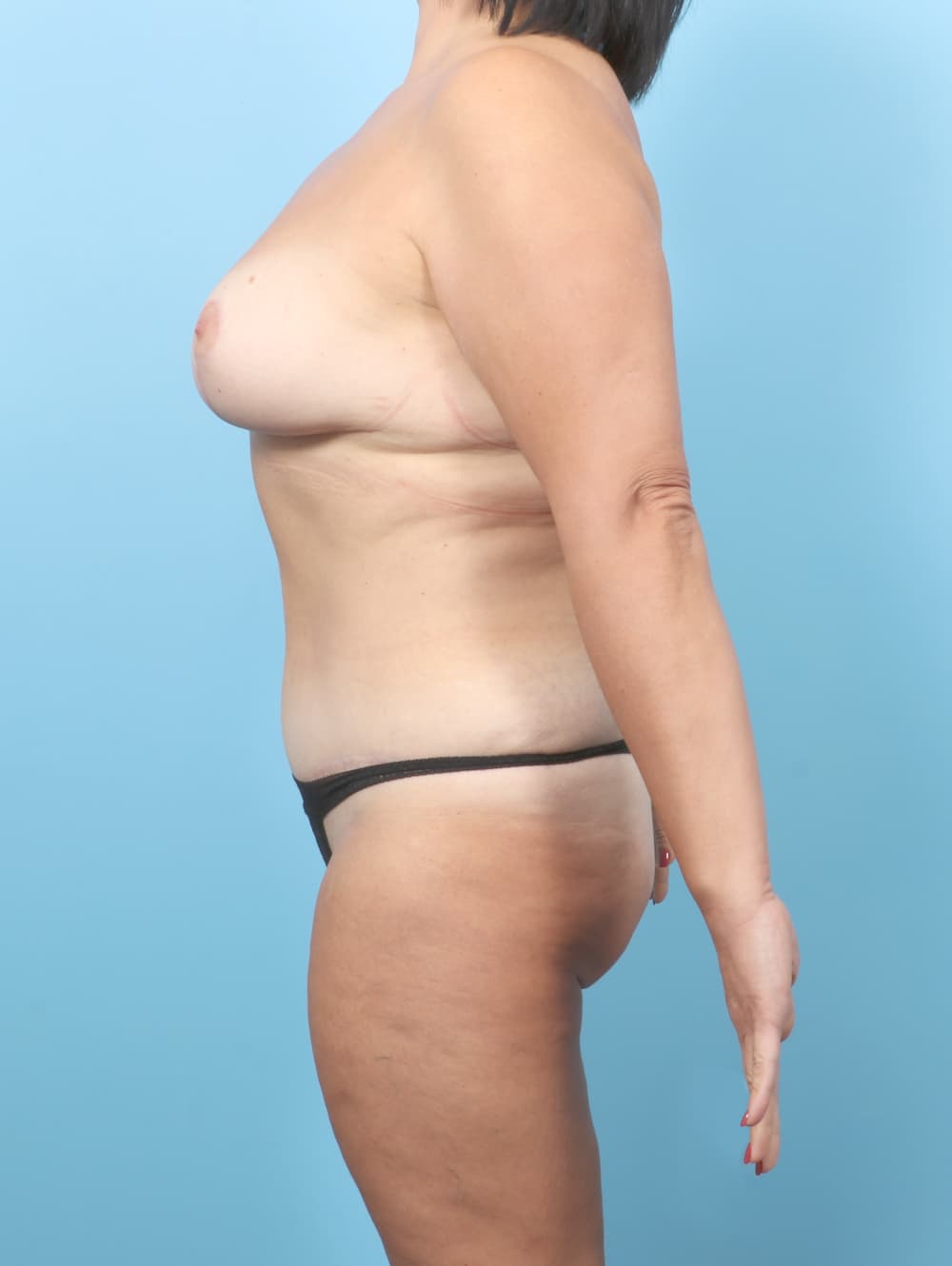 Tummy Tuck case #7660 after, image 3
