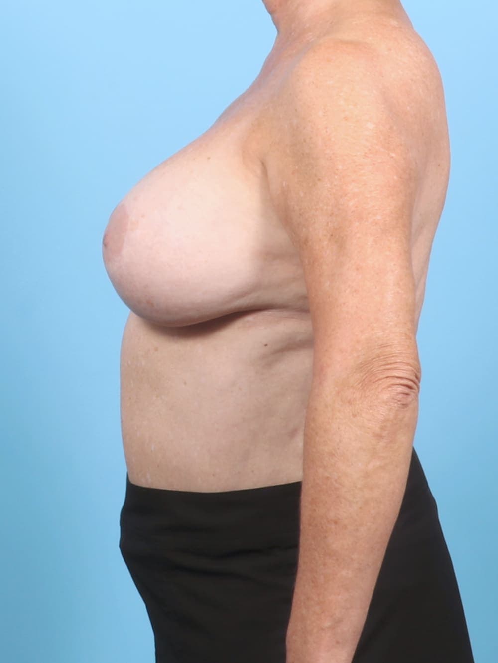 Breast Implant Removal with Lift case #6785 before, image 3
